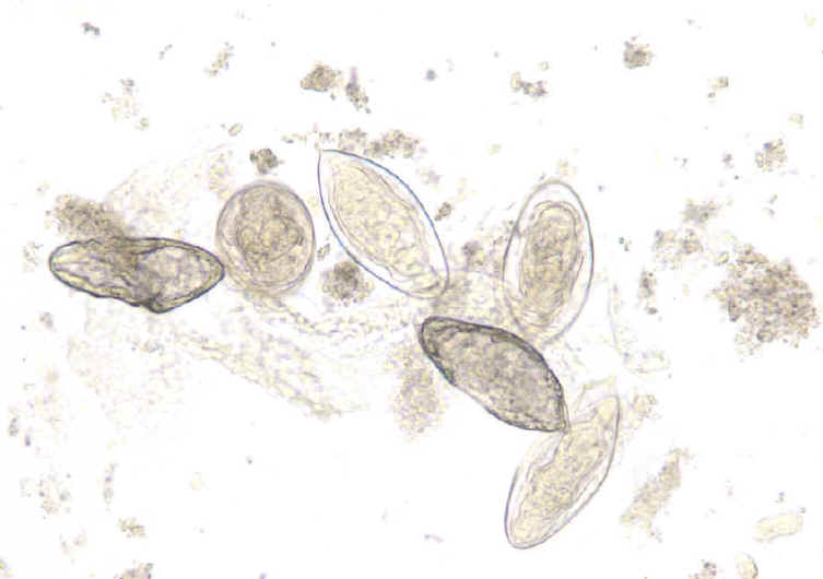 Schistosoma haematobium